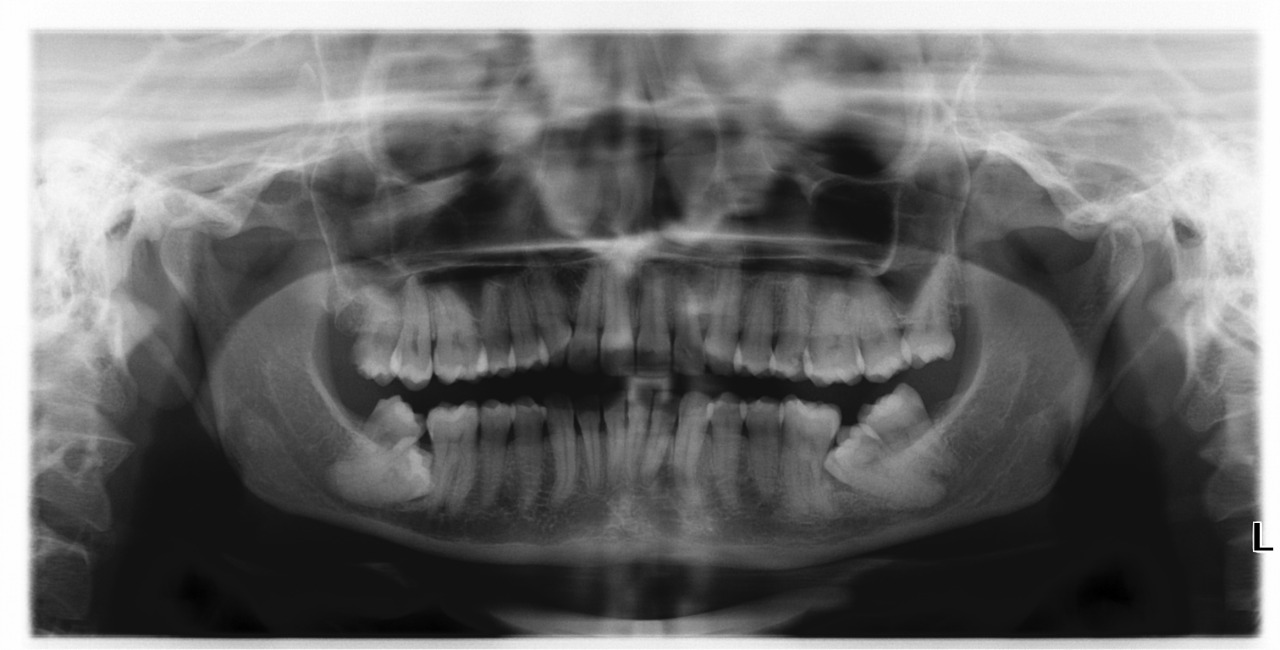 Impacted Second or Third Molar