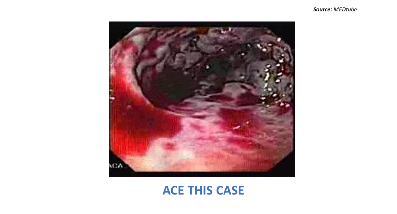 Diagnose the Cause of Bloody Vomiting in an Old Patient