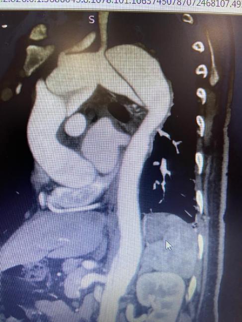 Frozen Elephant Trunk Procedure With Replacement of Aortic Root and Ascending Aorta in Retro Type A Dissection in Marphan Syndrome