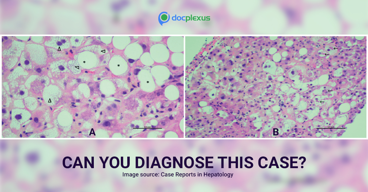 Diagnose This Case Based on the Liver Biopsy