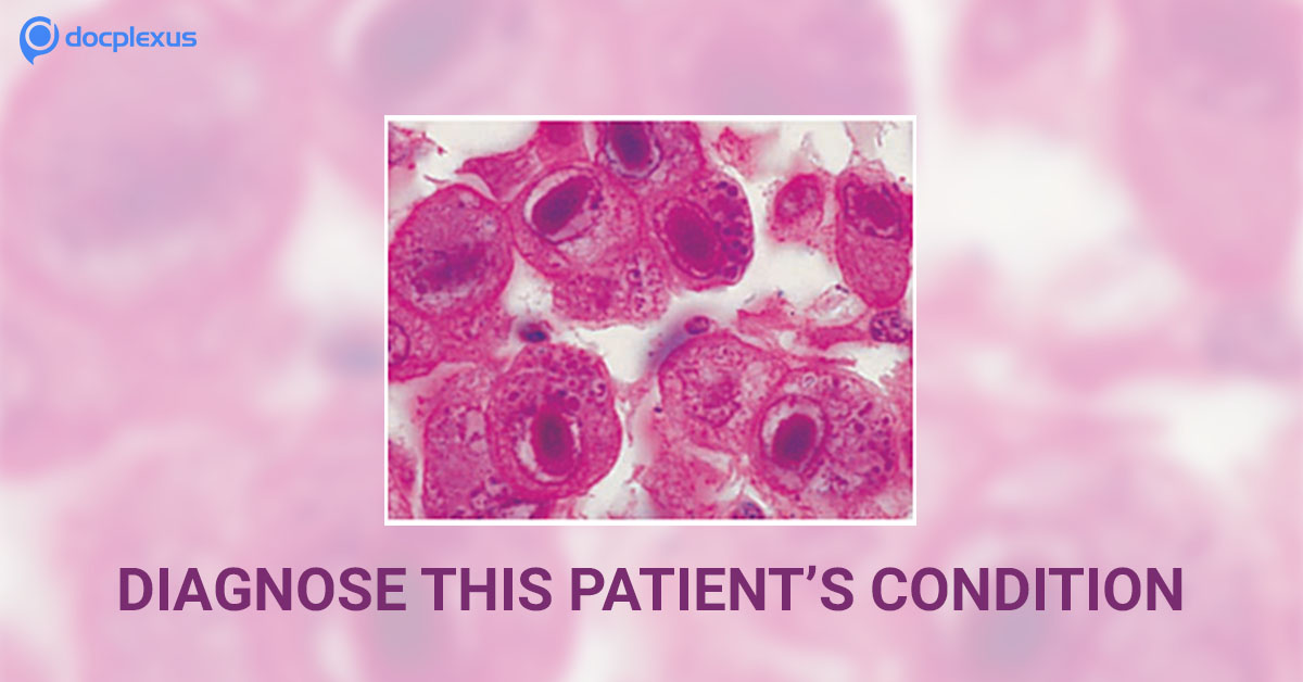 Case of a Colon Cancer Patient with Cough