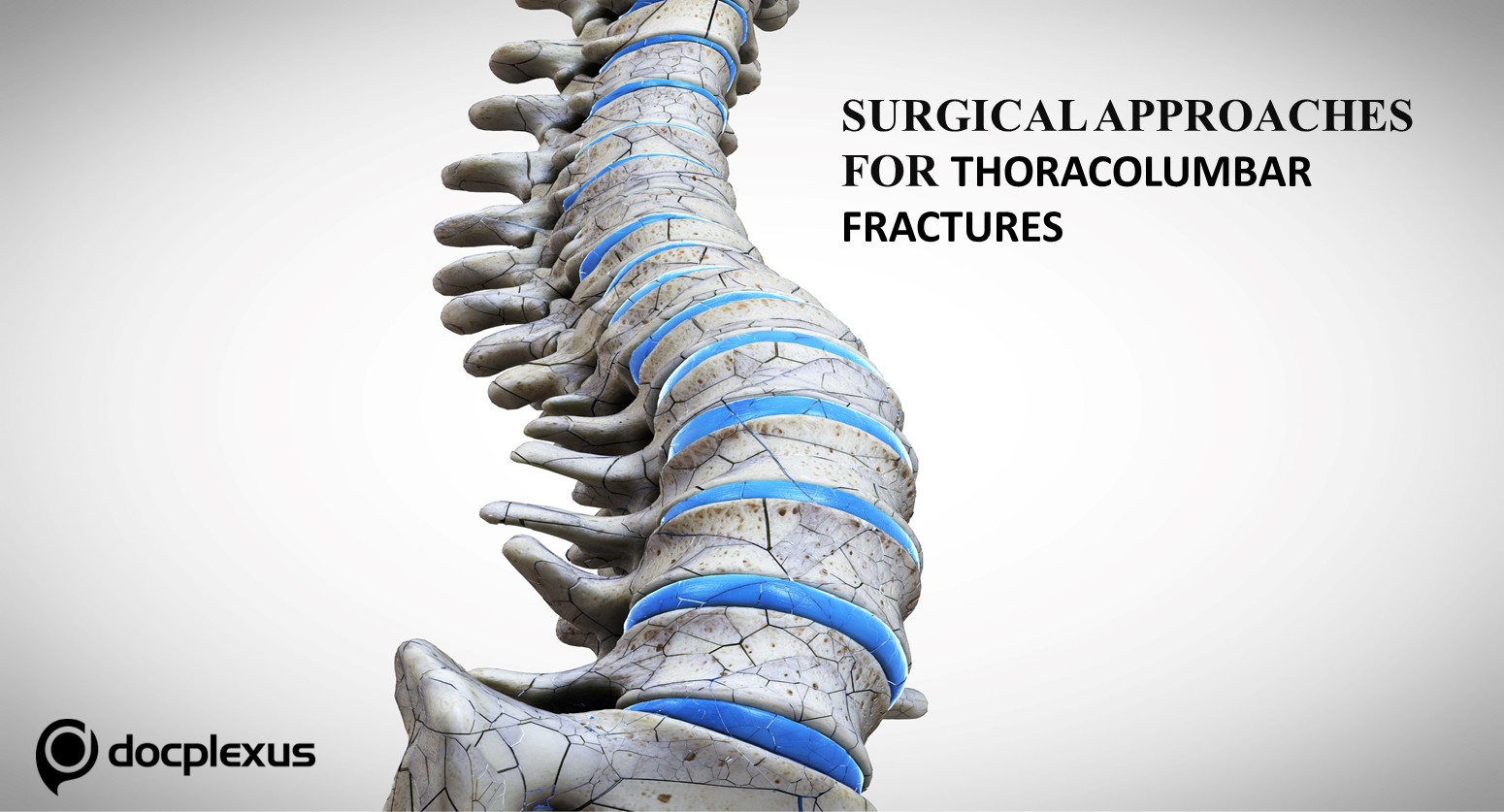 Thoracolumbar Fractures: Wiltse Approach vs. Percutaneous Pedicle Screw Fixation