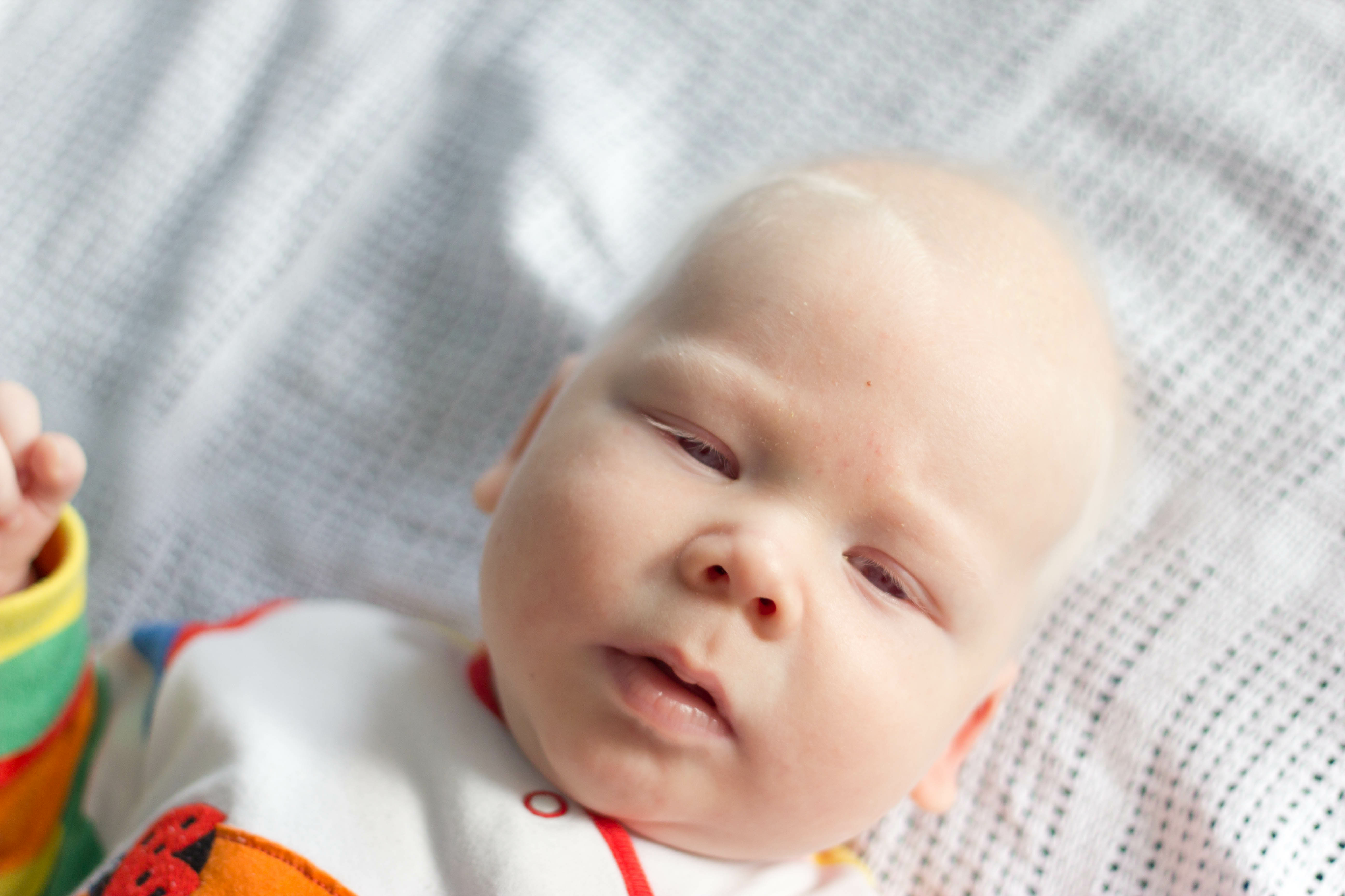 Hermansky-Pudlak Syndrome, A Rare Disease