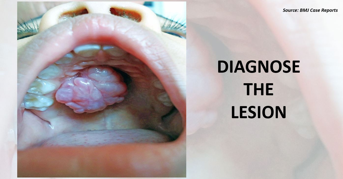 A 4-year-old With a Swelling on the Palate – What’s Your Diagnosis?