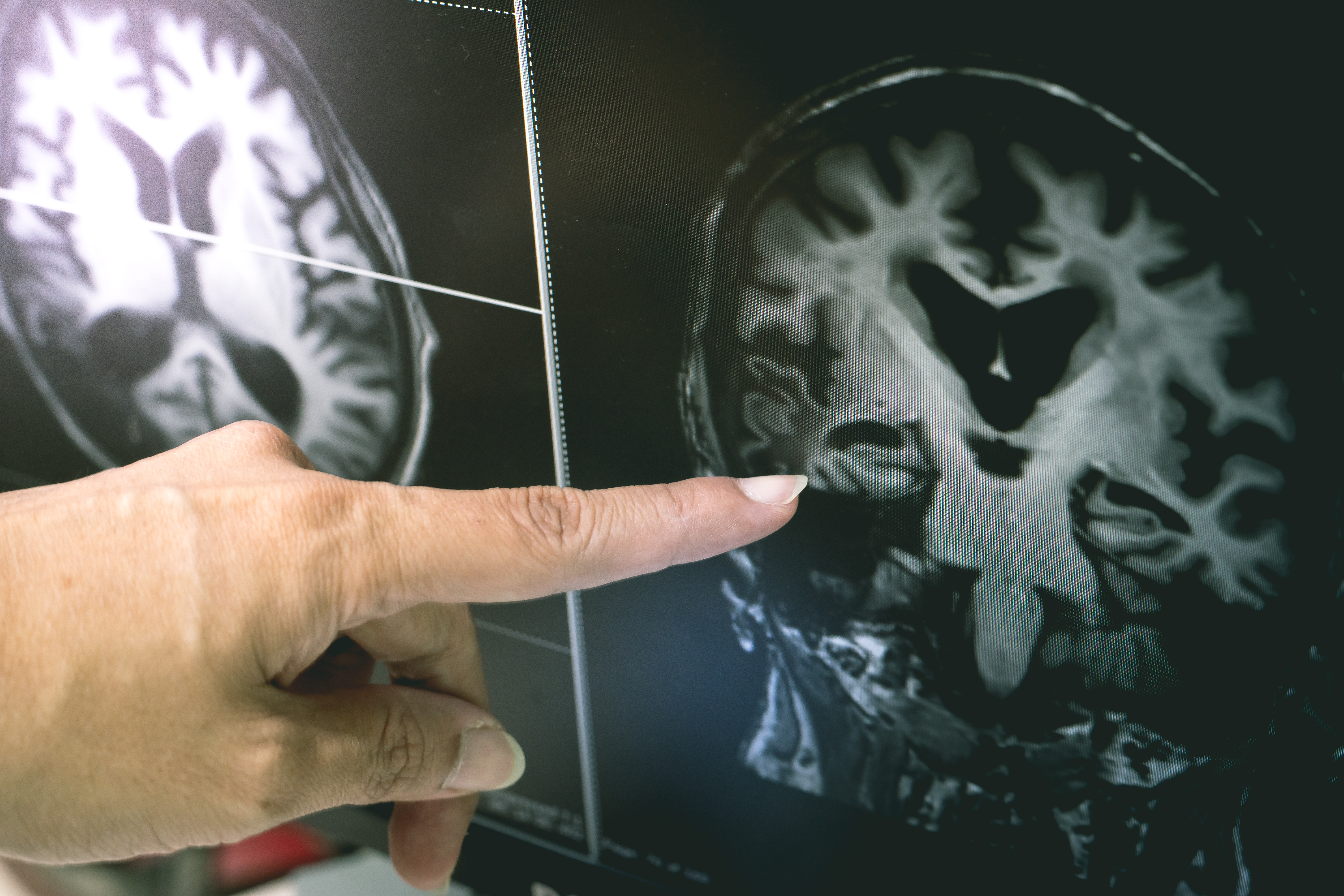 Pharmacological Treatment of Binswanger disease