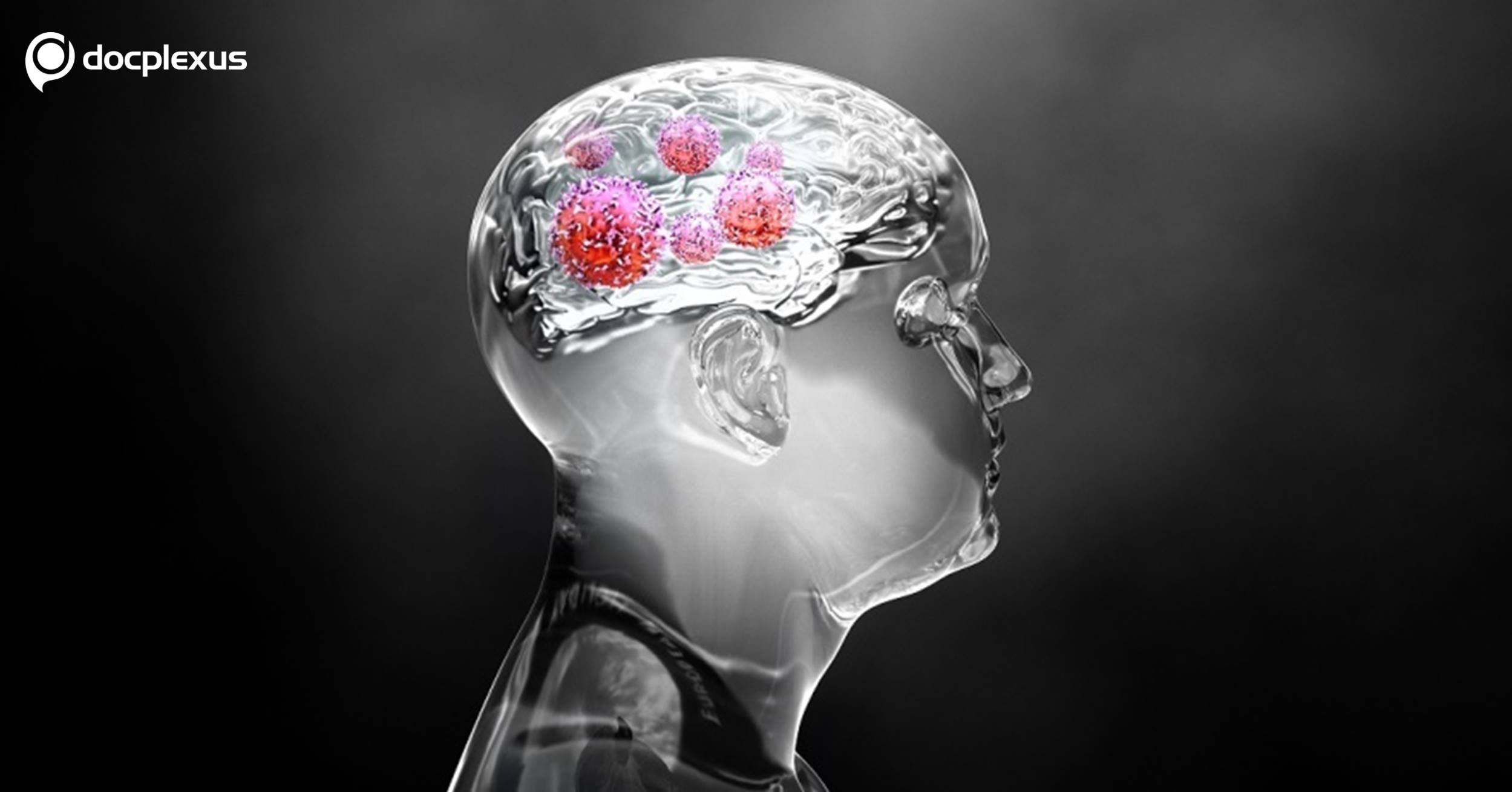 Ace this Quiz on Brain Tumors