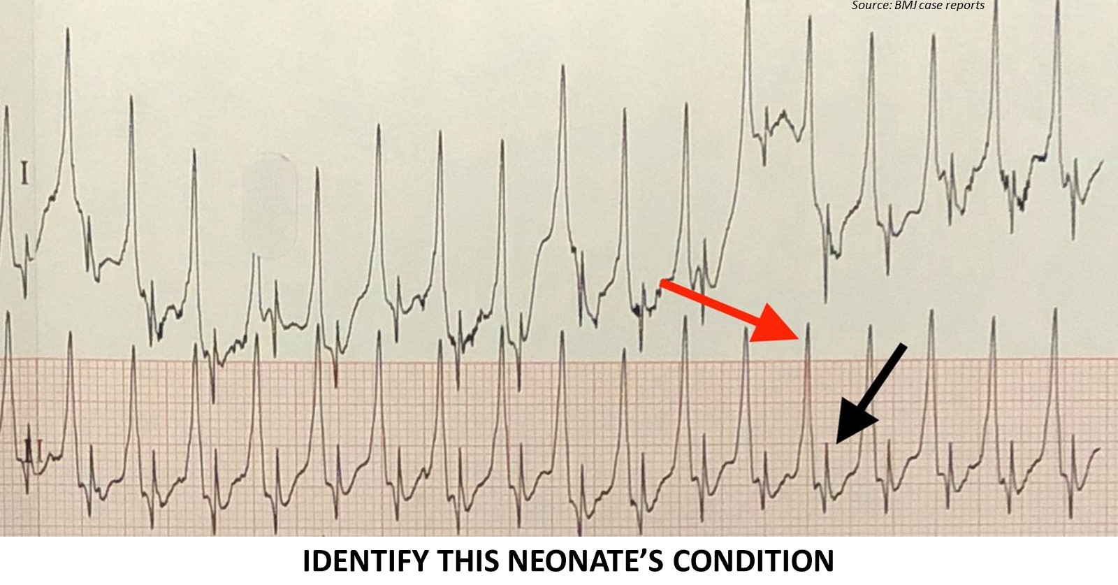 Case of Neonatal Fever and COVID-19 Infection