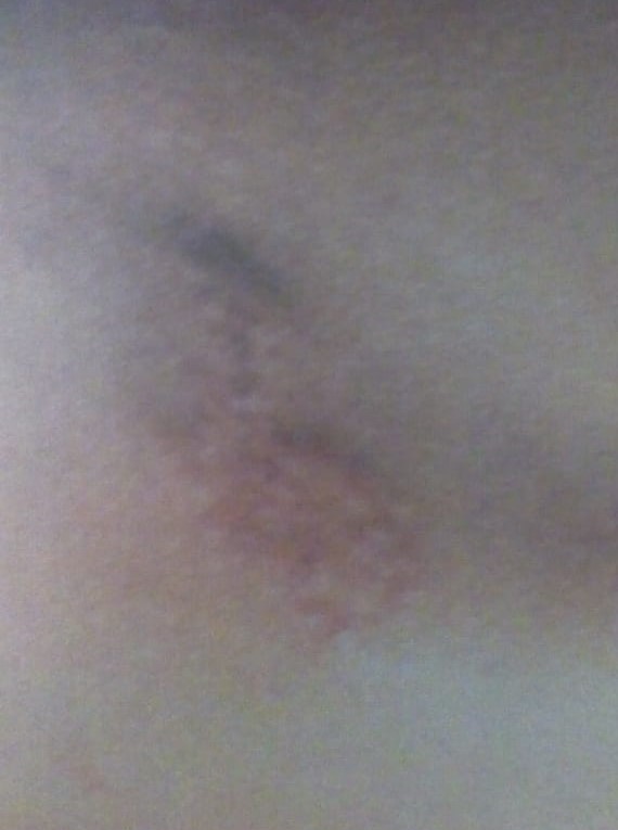 Look Alike Skin Lesion