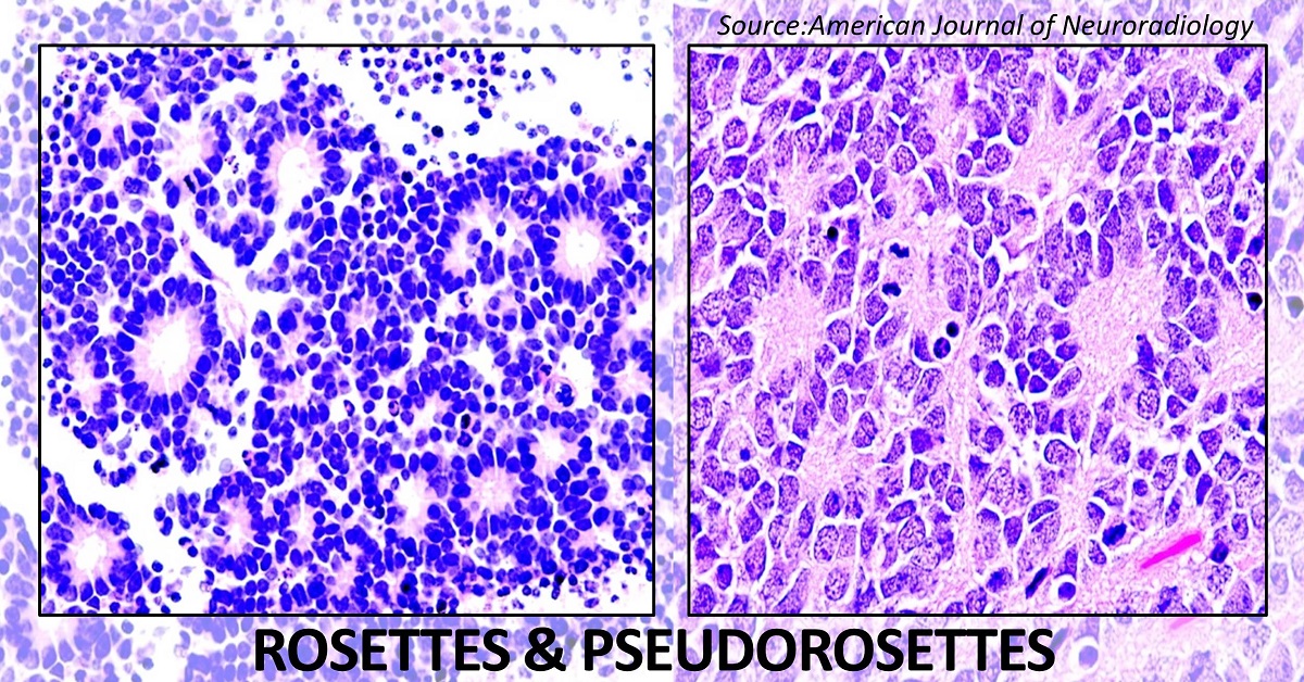 Ace This Quiz: Rosettes and Pseudorosettes in Pathology