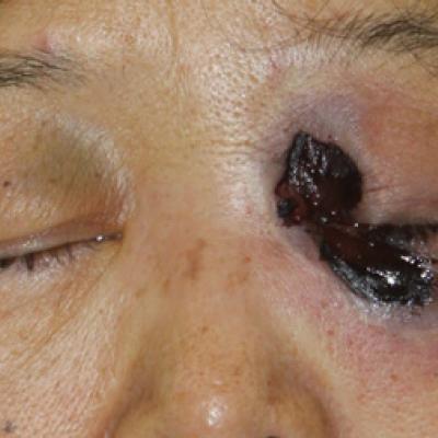 Do You Know Nasal Swabs are Unacceptable for Diagnosis of Mucormycosis?