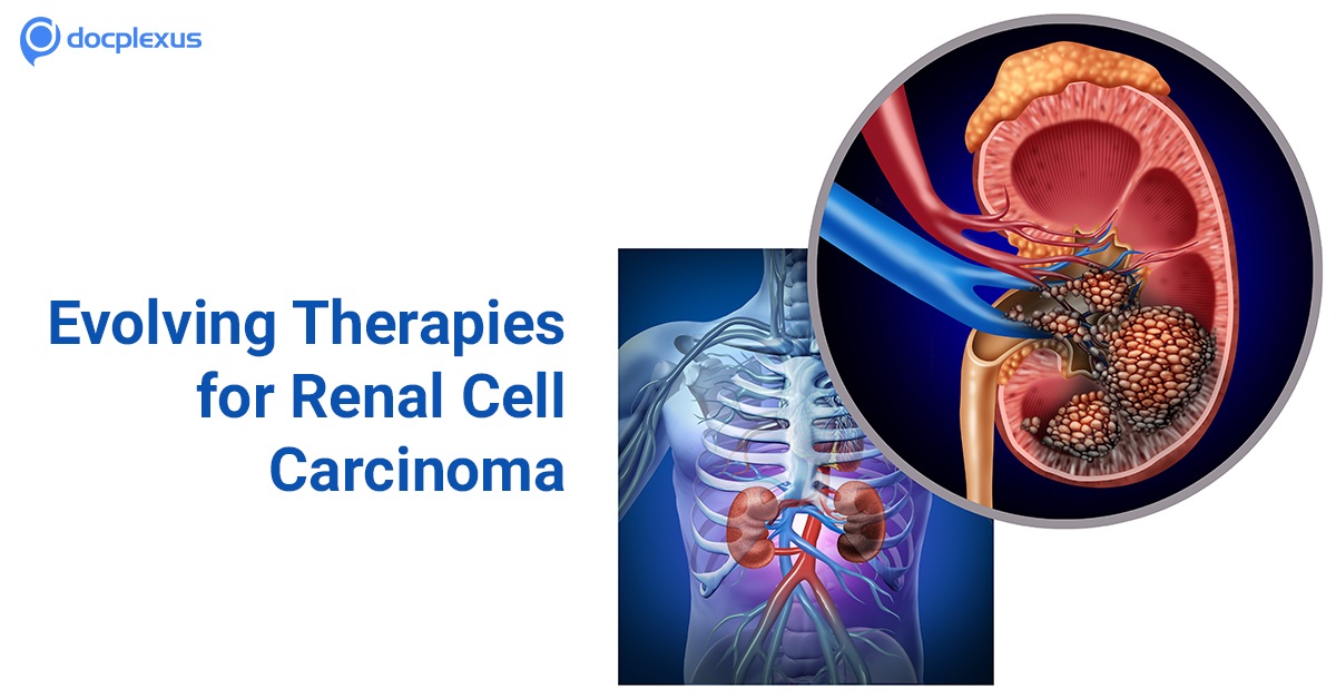 Biologics: A New Promising Therapy for Renal Cell Carcinoma