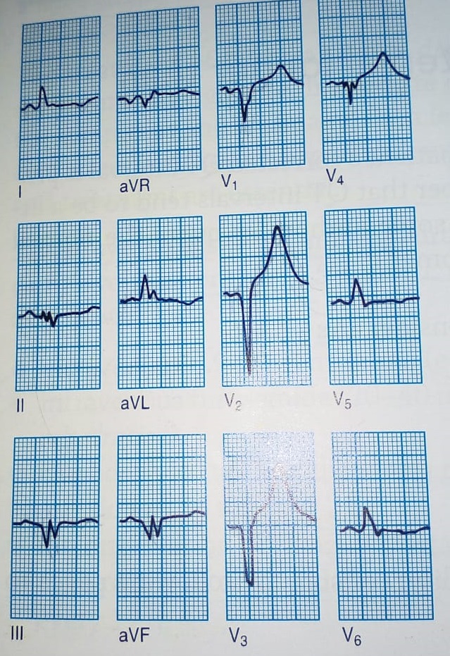 Is Albumin Estimation Mandatory Based On ECG?