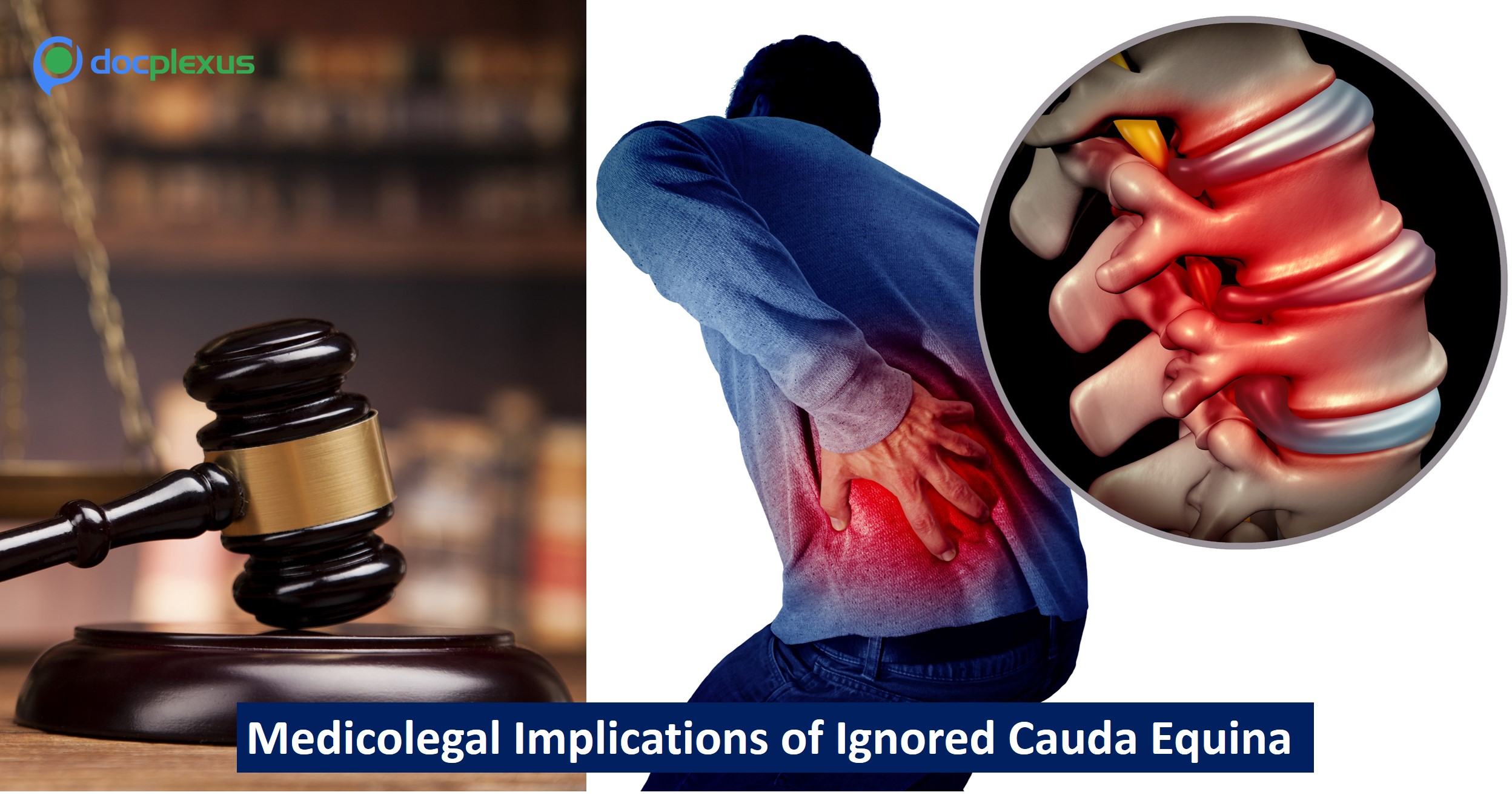 A Legal Case of Ignored Cauda Equina