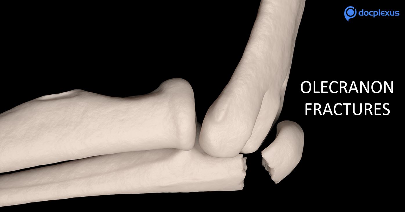 Answer This Question on Olecranon Fractures