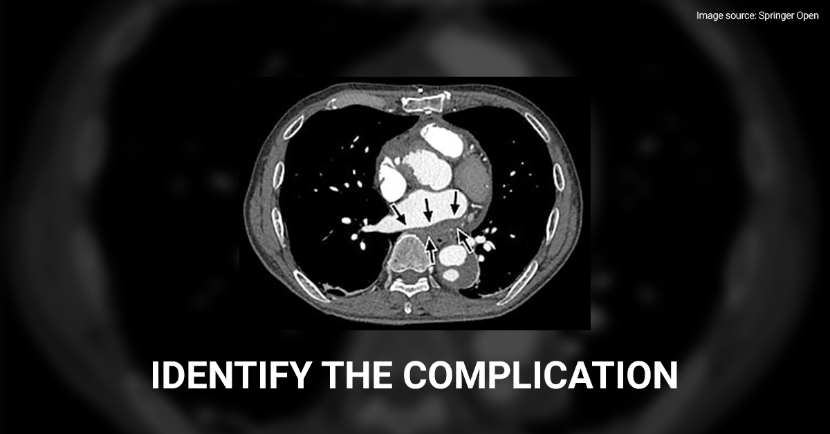 Case of a Man with Type A Aortic Dissection
