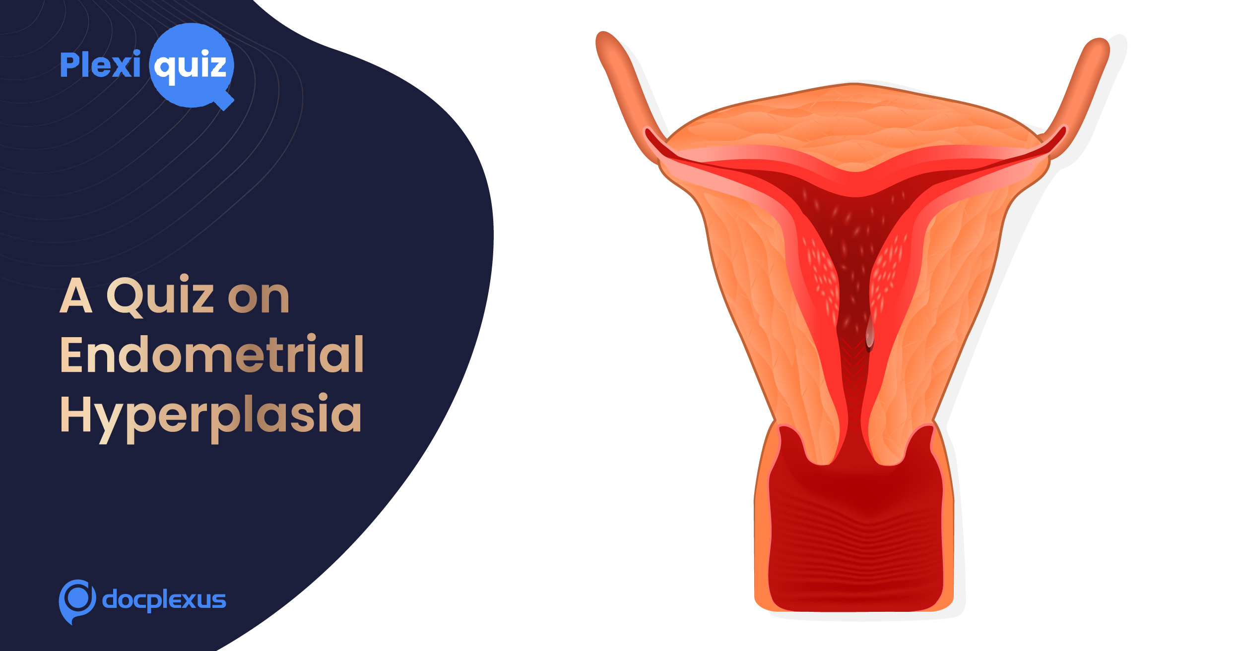 Test Your Knowledge of Endometrial Hyperplasia