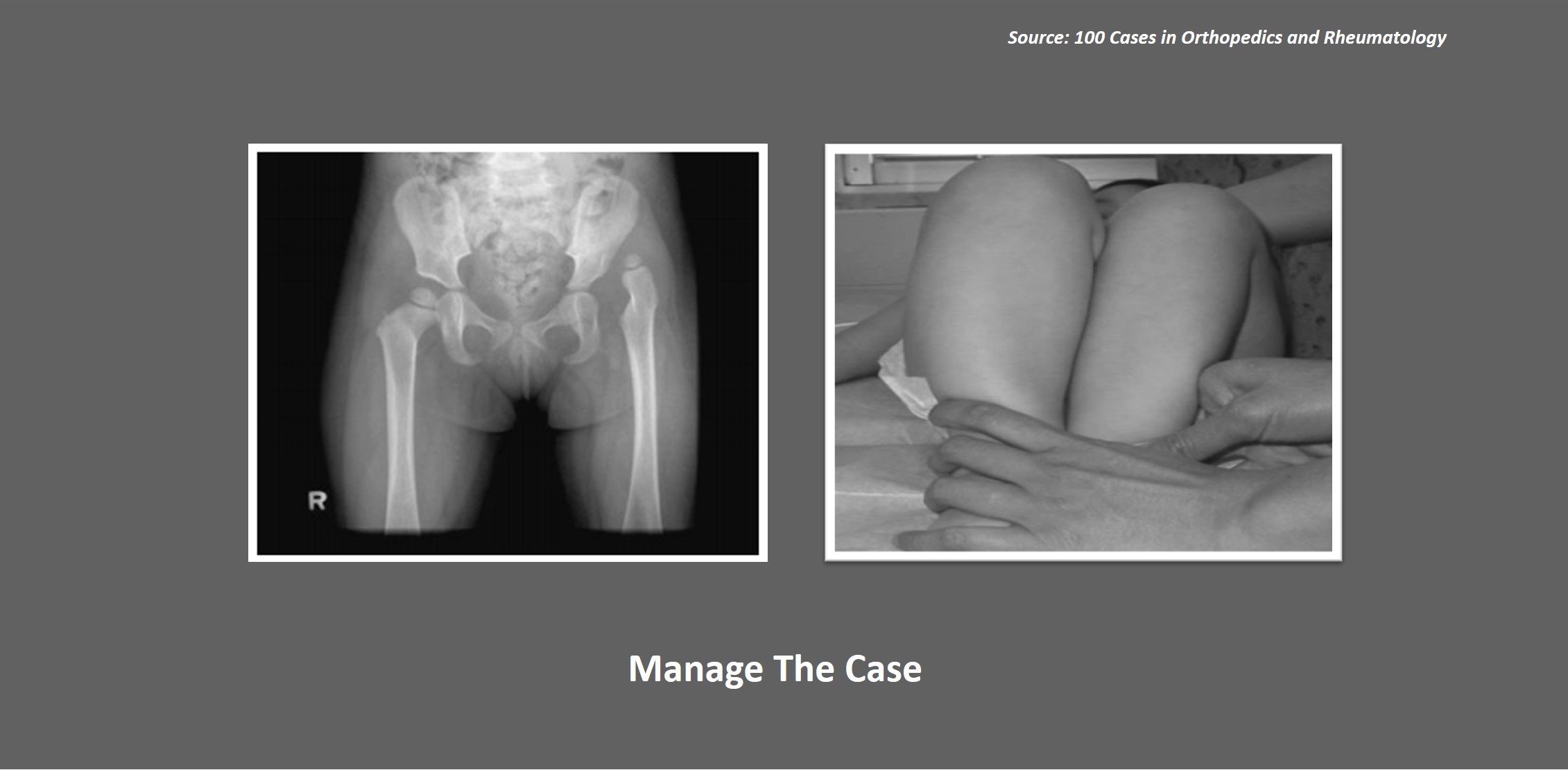 Manage This Pediatric Case of Hip Clicking