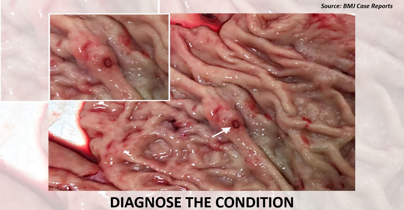 Identify the Reason Behind Hematemesis in This Elderly Woman
