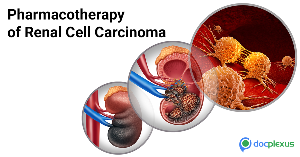 Brainstorm Your Knowledge About Renal Cell Carcinoma