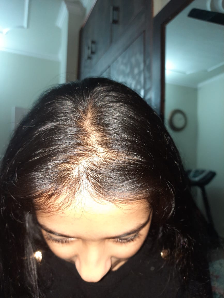 Teenage Hair loss