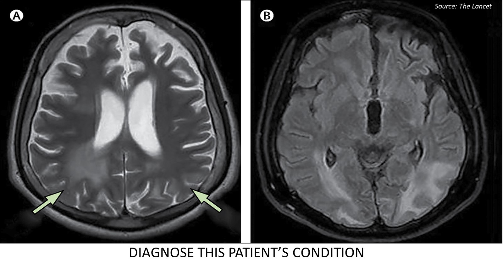 Case of a Man with Tonic-Clonic Seizures