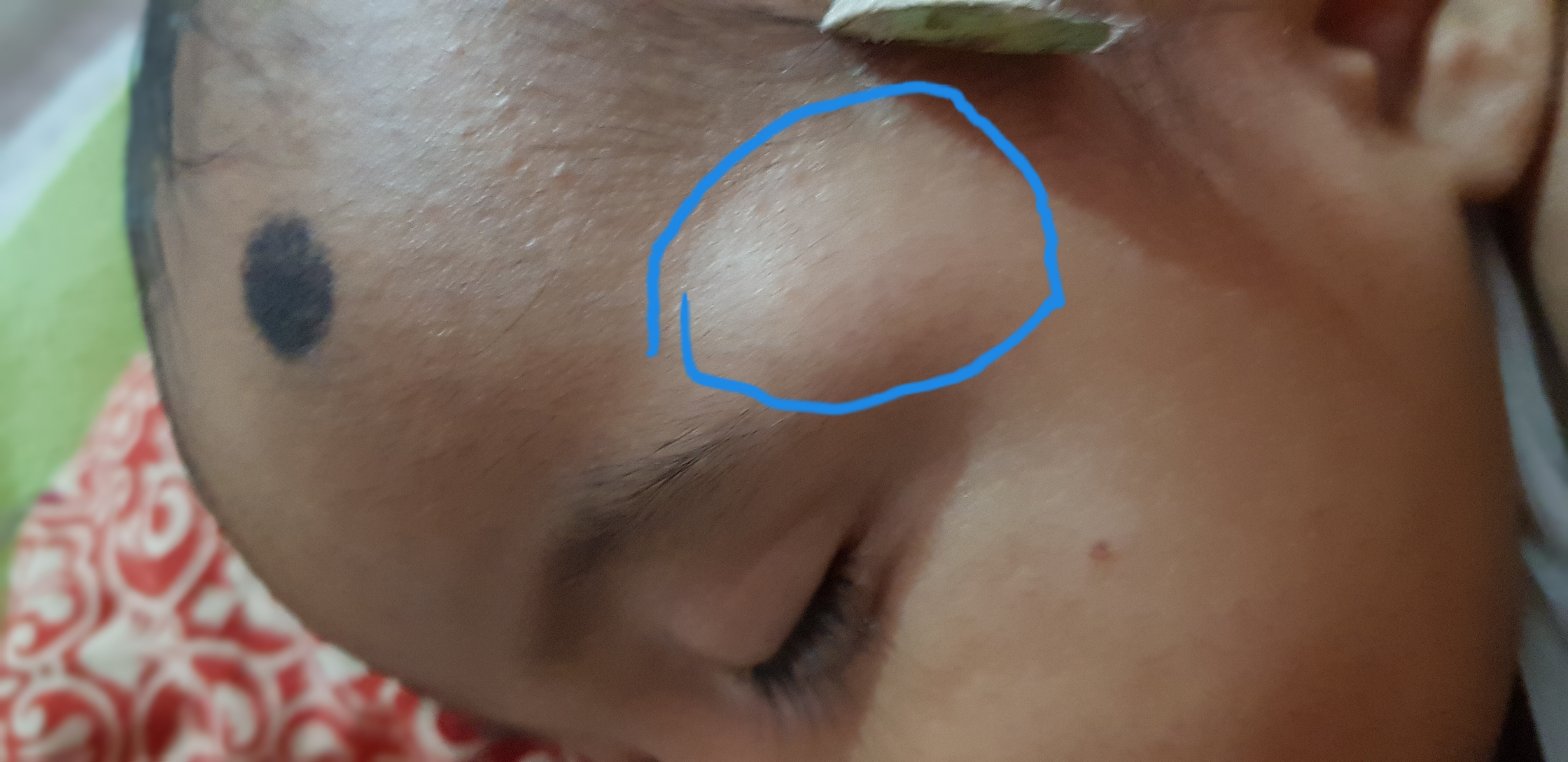 A Case of a 5 Month Old Baby with Dermoid Cyst/ Nodule