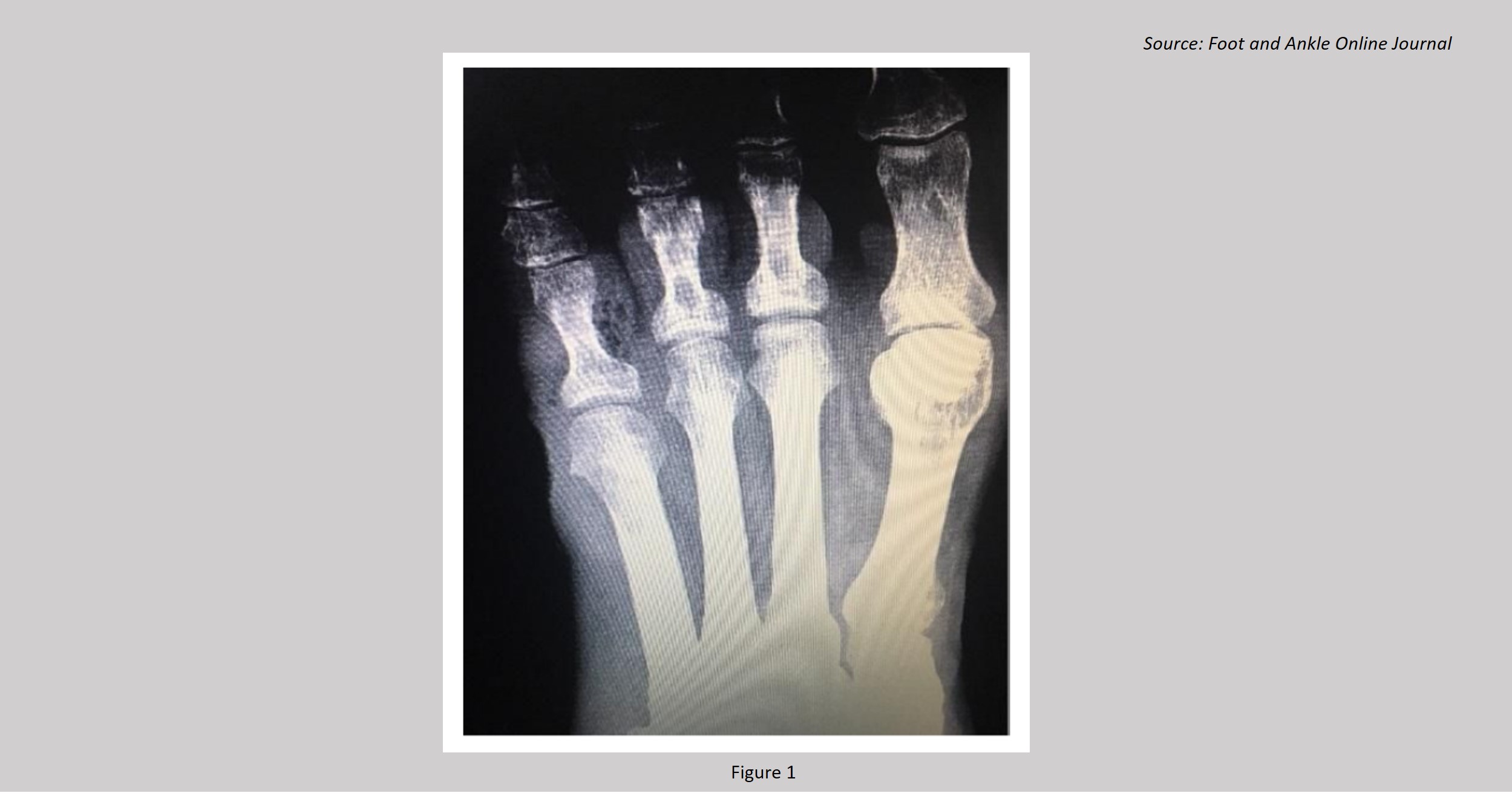 A Case of Rare Microbial Infection Post-amputation