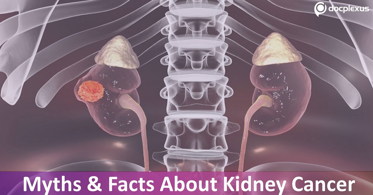 Myths & Facts About Kidney Cancer