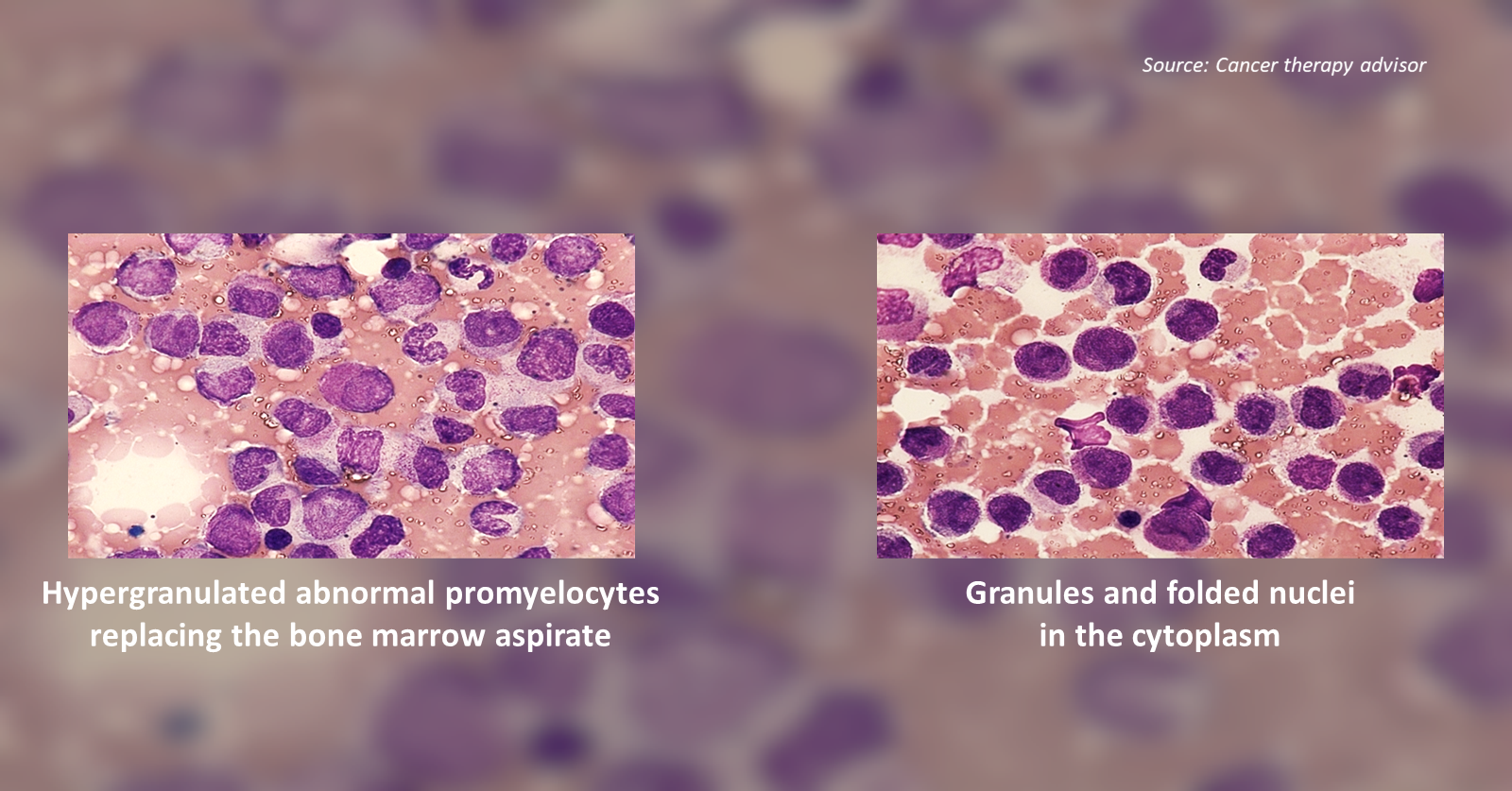 Case of a Woman with Pancytopenia