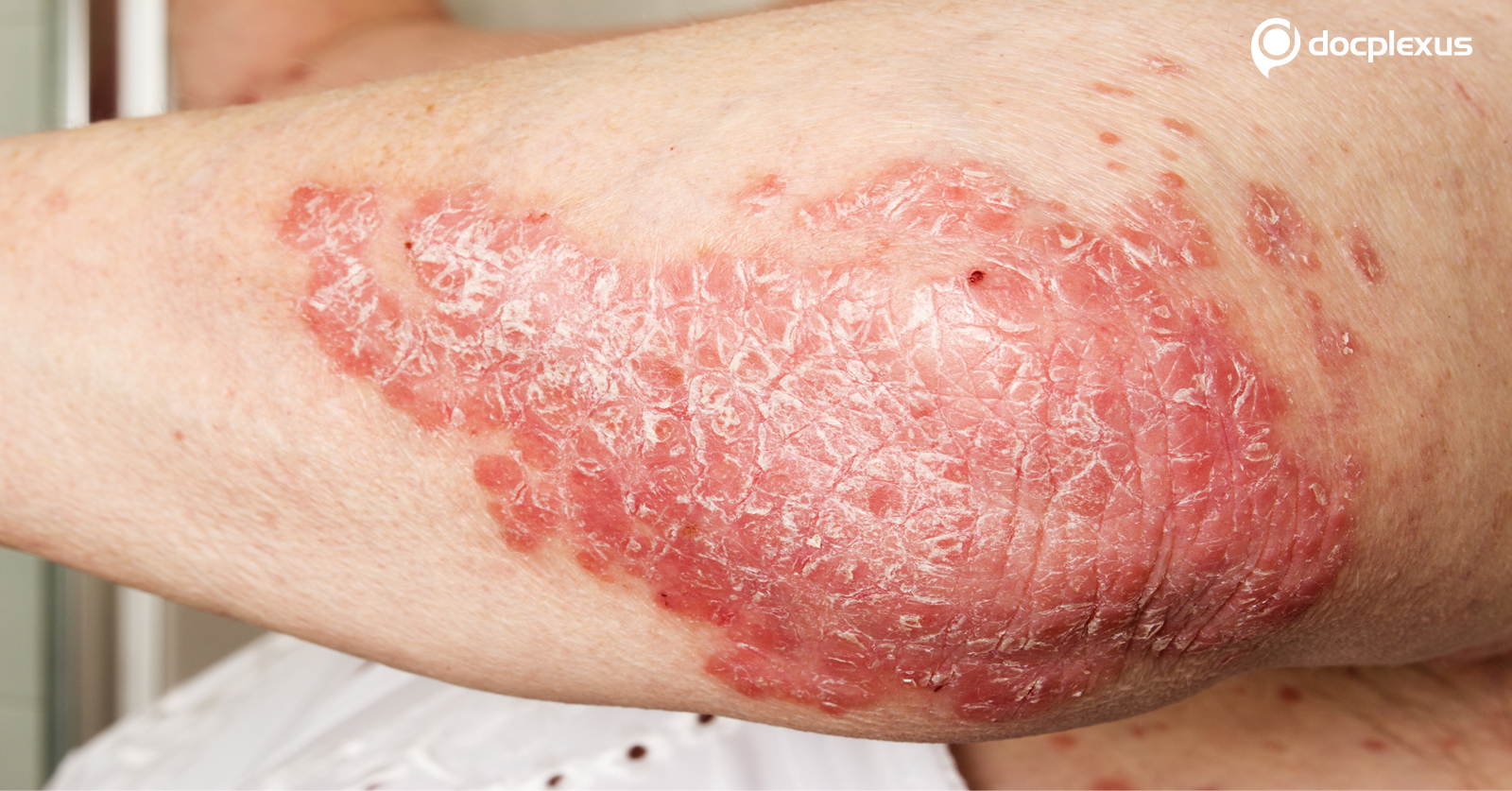 Dry Red Patches Over Elbows and Knees