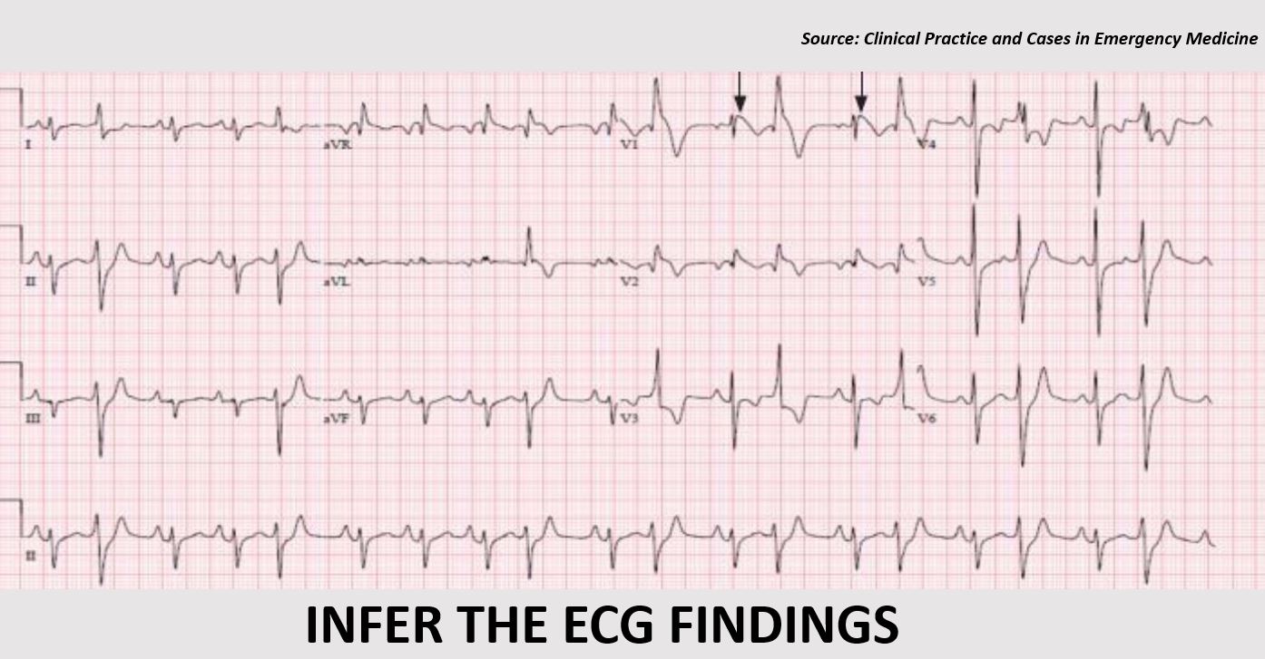 Fever and Abnormal ECG in a Pediatric Patient