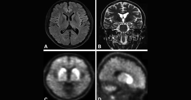 A Young Man With Declining Cognitive Functions