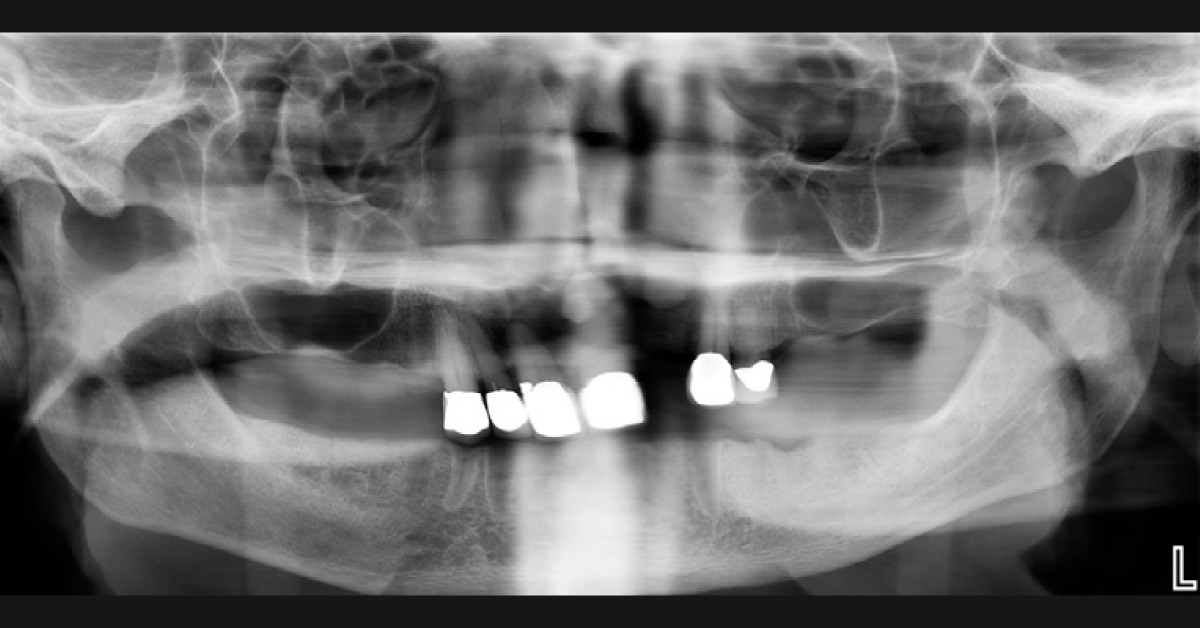 An Elderly Man With Painful Ulceration