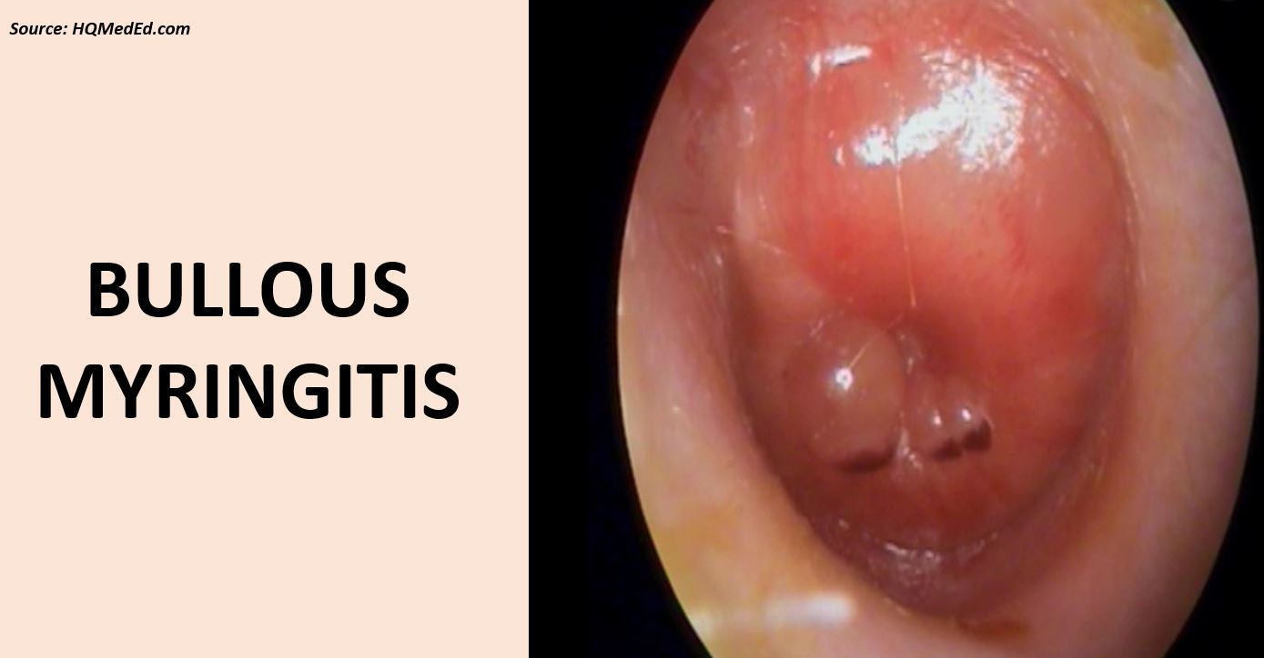An Overview of Bullous Myringitis