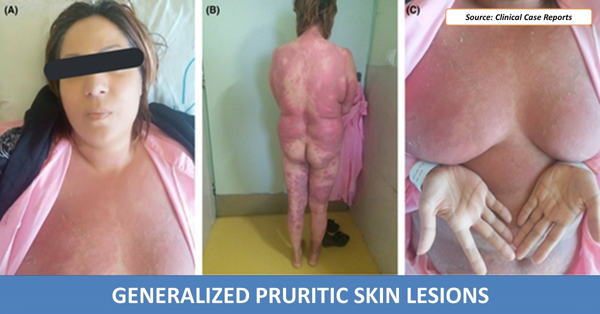 Case of a Female with Generalized Pruritic Skin Lesions