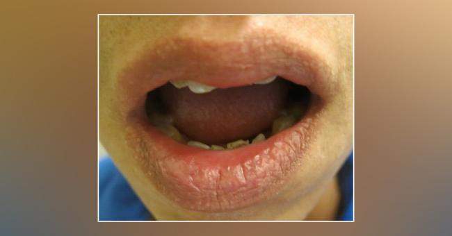 Multiple Spots on the Lips