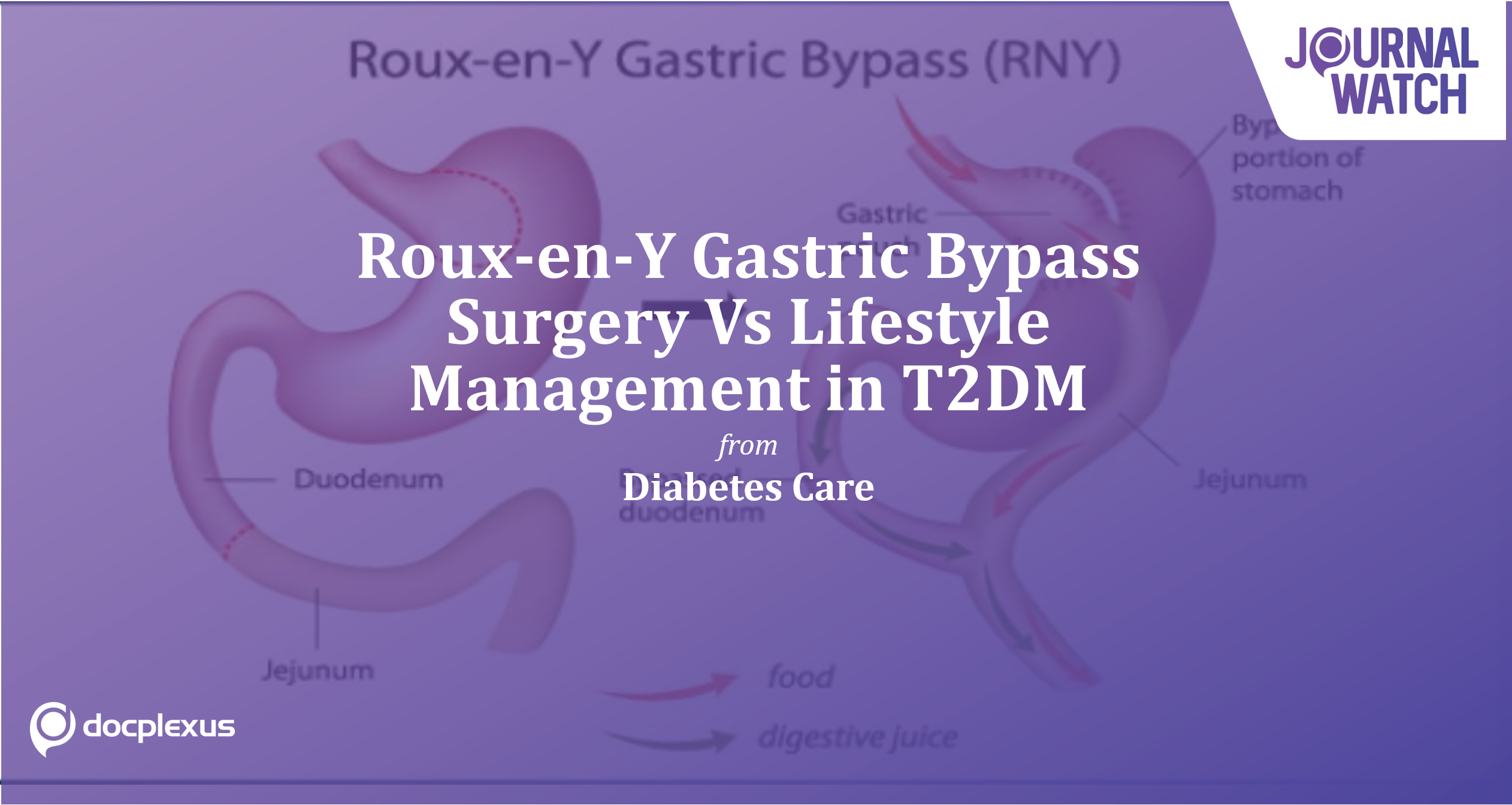 Roux-En-Y Gastric Bypass Surgery Vs Lifestyle Management For T2DM