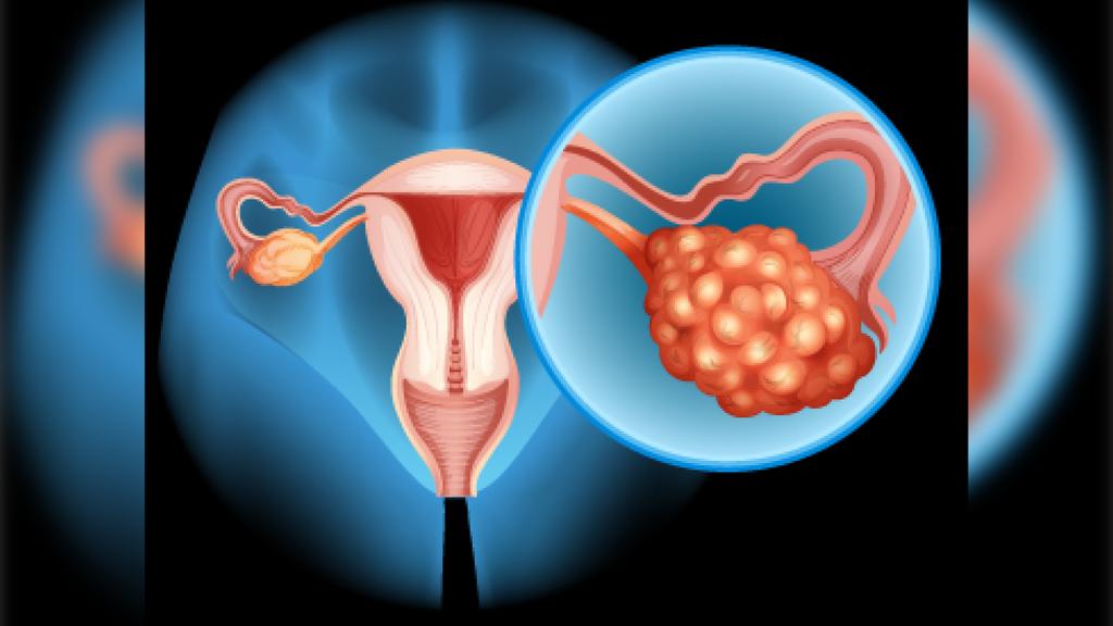 A Microenvironment Chip to Test Novel Ways to Treat Ovarian Cancer