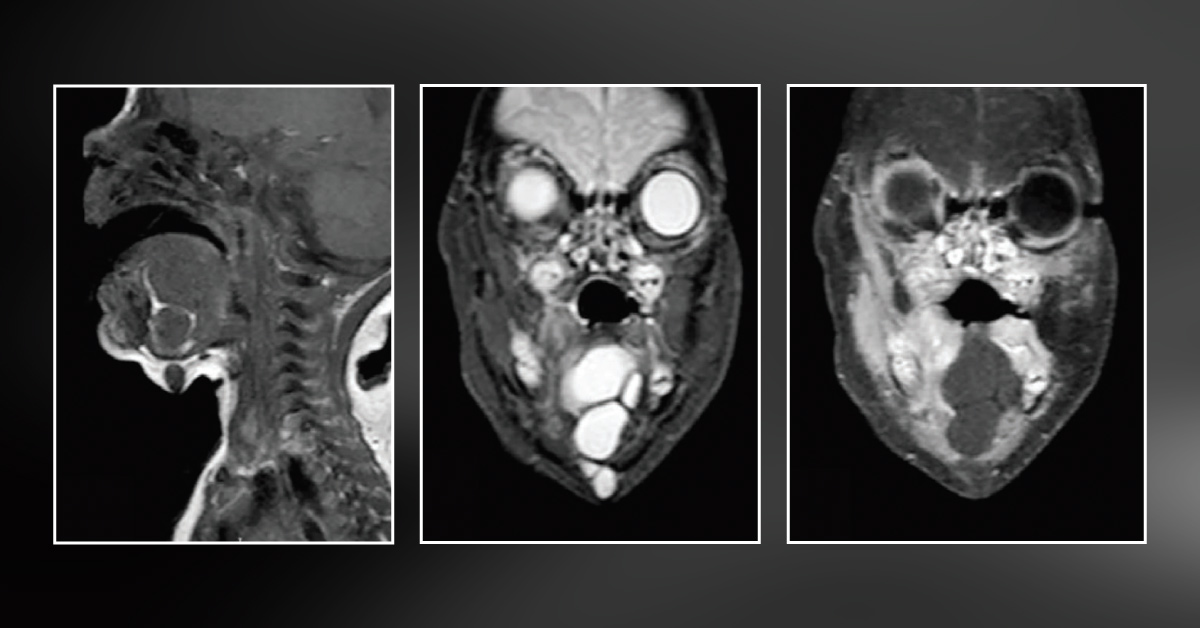 Neonate with Sublingual Mass
