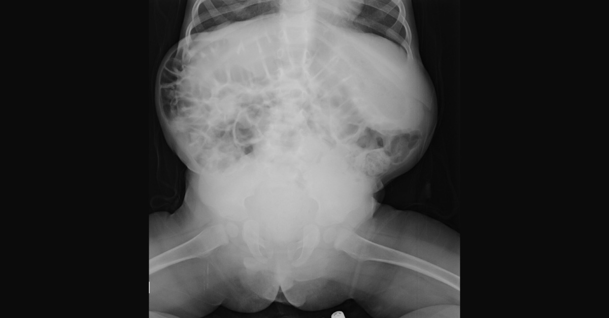 Pediatric Case of Acute Hematuria