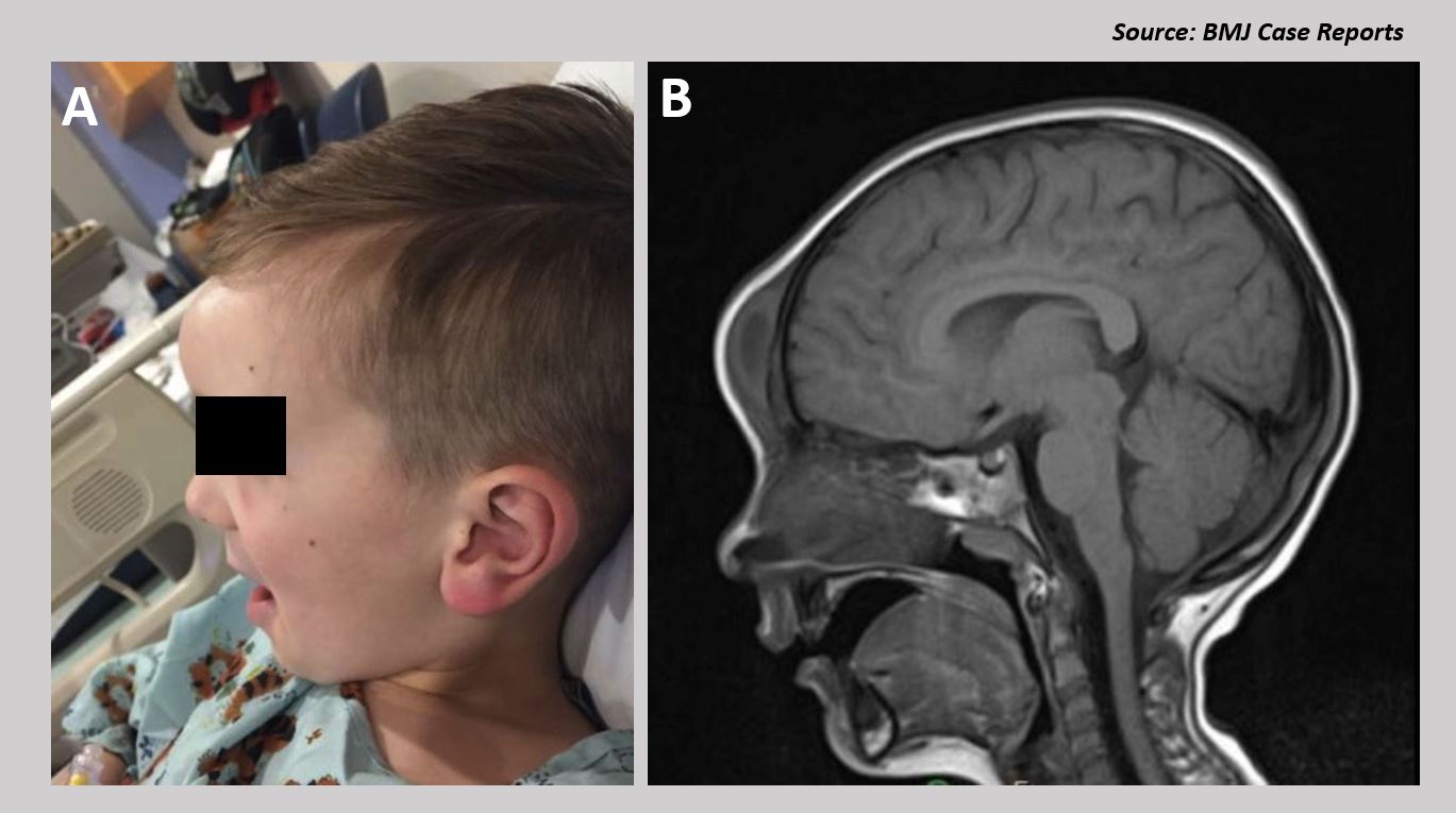 Forehead Swelling in A 5-year-old Boy, What’s Your Diagnosis  ?