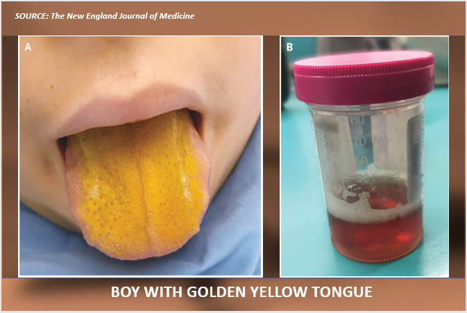 Rare Disease With an Icteric Tongue