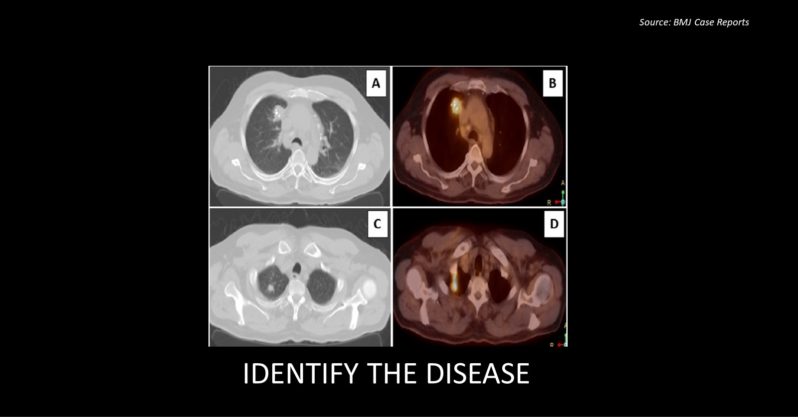 What’s Your Diagnosis for This Man with Stage 1 Adenocarcinoma of the Rectum?