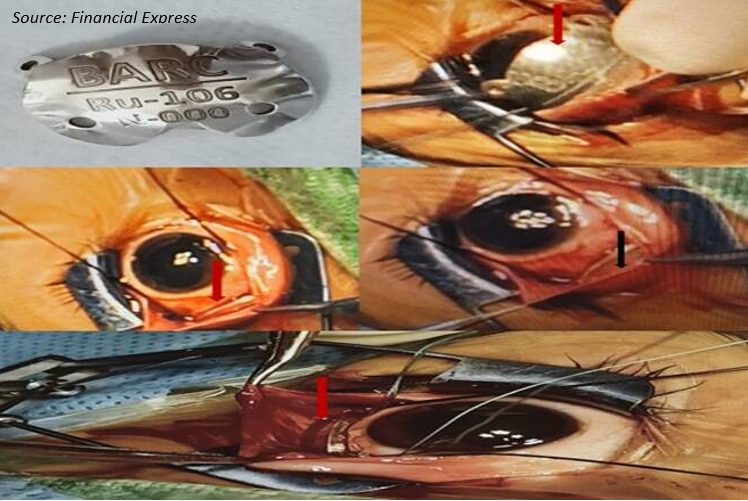 Plaque Brachytherapy: Another Feather in AHRR’S Cap