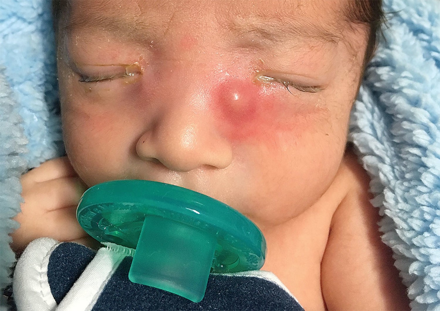 An Infant With Red Draining Eyes