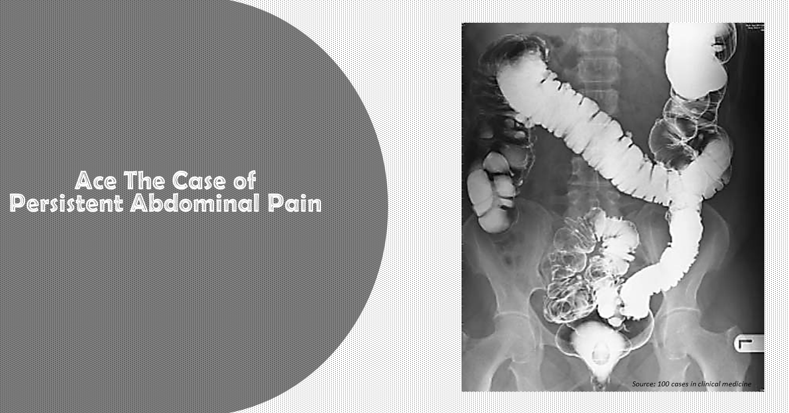 Identify the Reason Behind Persistent Abdominal Pain
