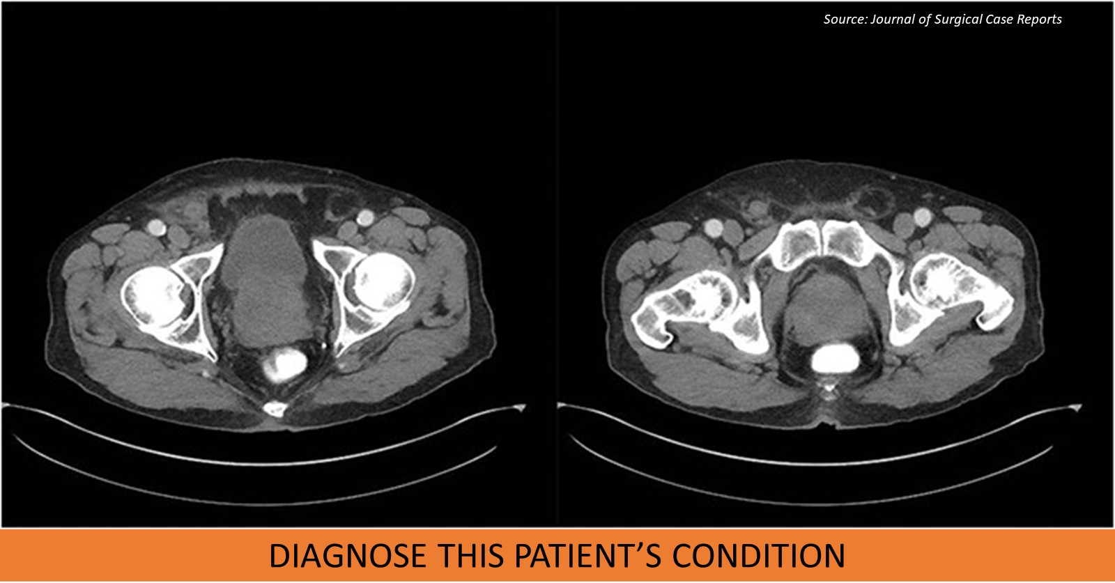 A Man with Vague Abdominal Pain Migrating to His Right Groin