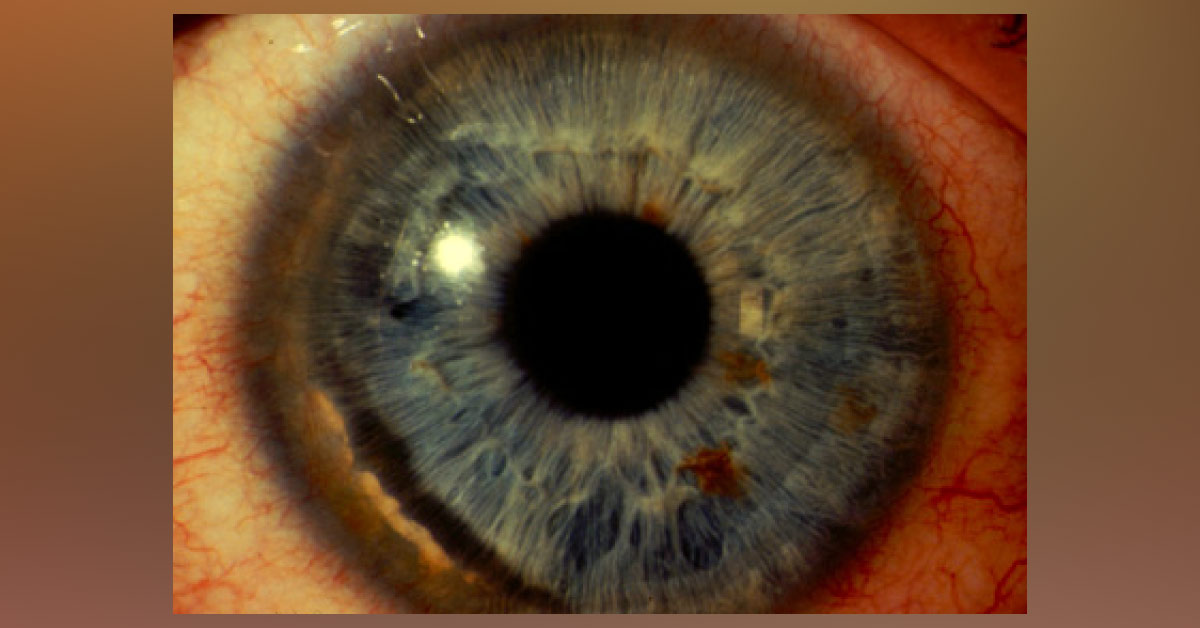 A Male with Asymmetric Vision Loss