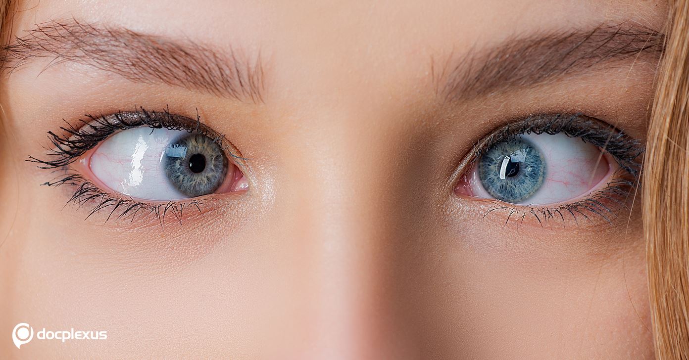 Answer This Question on Strabismus