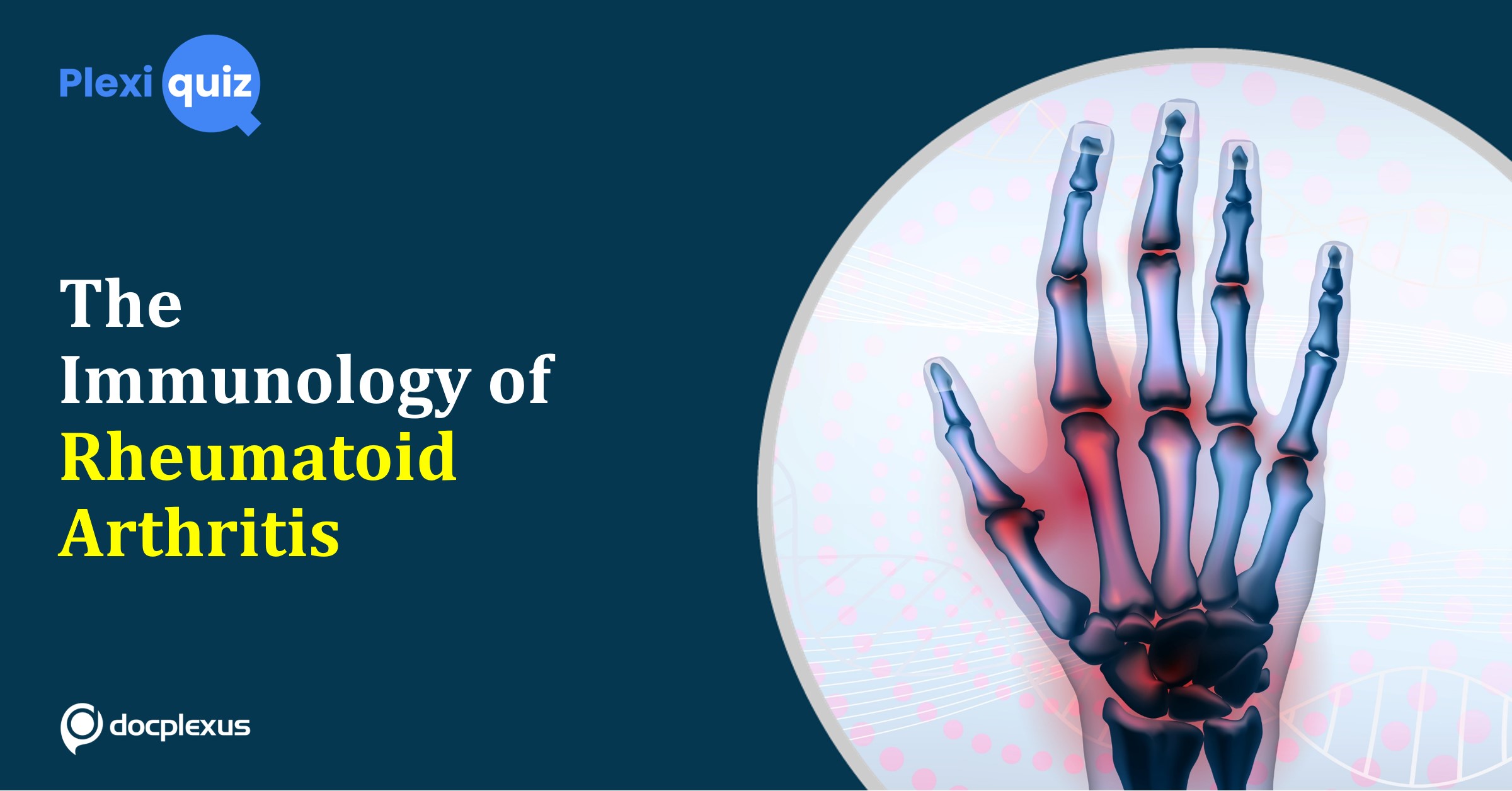 Ace This Quiz on the Immunology of Rheumatoid Arthritis